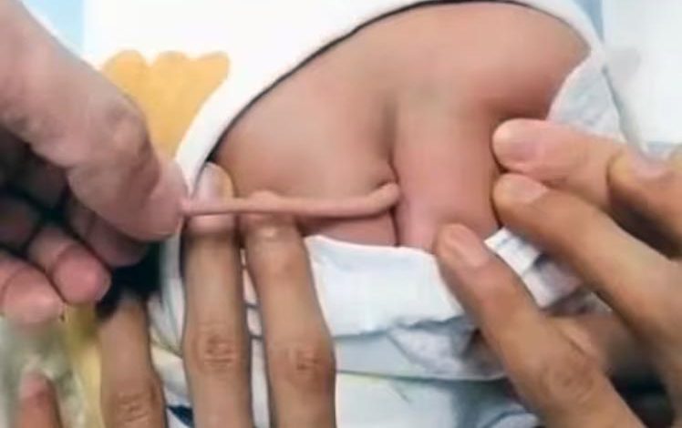 Spina Bifida, Human Baby With Tail, Baby With Tail, Human Tail, Baby Tail, Child Tail, Rare Birth Defect, Strange Case In China